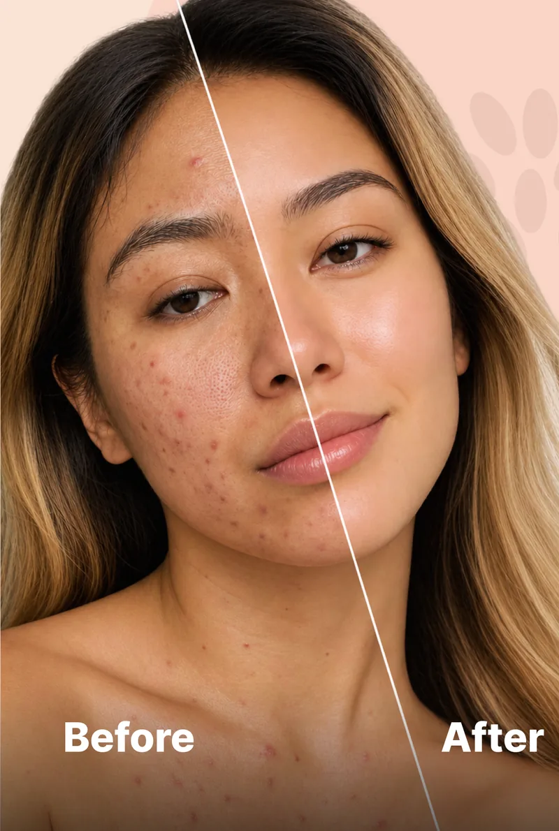 A person's face before and after months of reduced skin picking