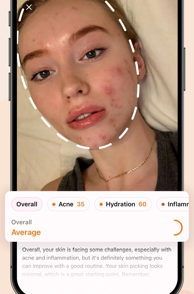 Serena's AI skin scan scoring acne, hydration and inflammation